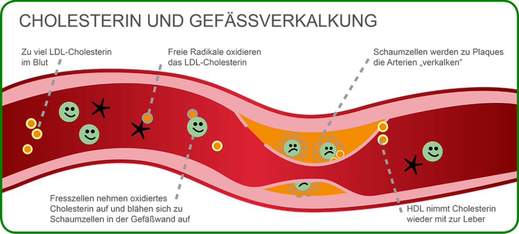 Grafik zur Gefäßverkalkung durch Cholesterin