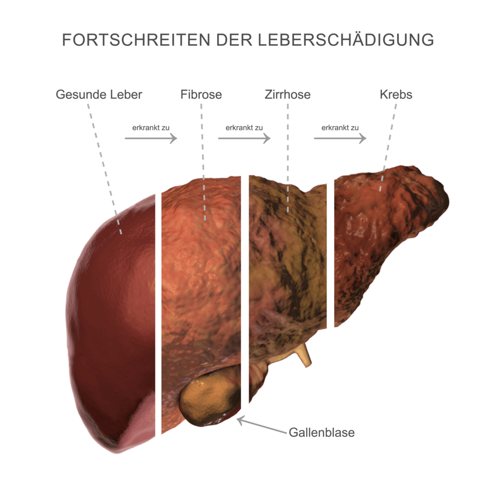 Fortschreiten von Leberschäden: Fibrose kann zur Zirrhose werden und sich schließlich zu Leberkrebs entwickeln