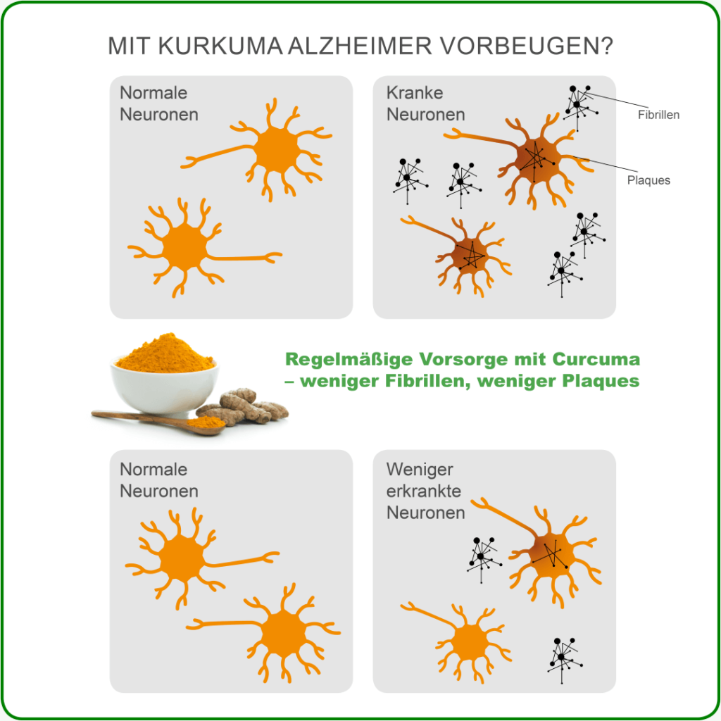 Bei Alzheimer-Demenz bilden sich Fibrillen und Plaque-Ablagerung im Hirn. Wie Kurkuma dagegen hilft, haben Wissenschaftler in vielen Studien untersucht.